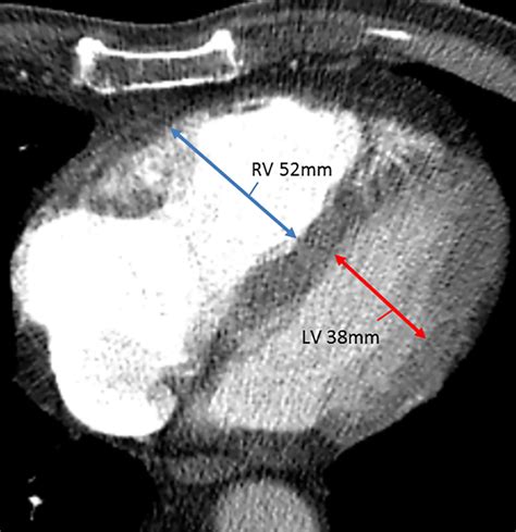 rv lv ratio pe|signs of right ventricular strain.